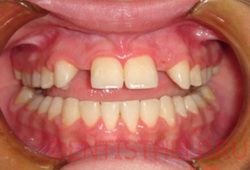 частичная адентия зубов