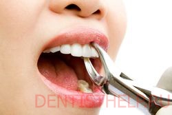 показания к удалению зубов