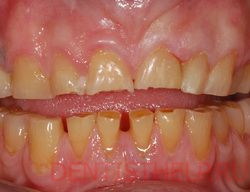 Неравномерная нагрузка - причина стираемости зубов