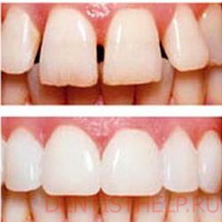 преимущества реставрации зубов композитами