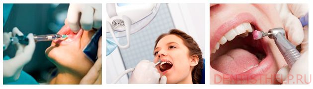 этапы сверления зуба
