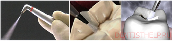 Чистка зубов Air Flow: технология проведения