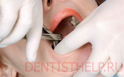 причина альвиолита - инфицирование лунки во время удаления зуба