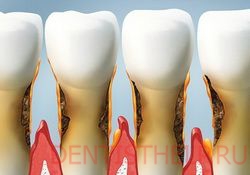 скопление зубного налета и камня на зубах показания для профессиональной чистки зубов
