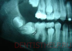 давление со стороны соседних зубов - причина ретенции зуба