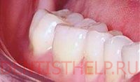 лечение эмали зубов