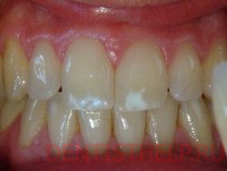 флюороз - одно из показаний к реставрационному отбеливанию зубов