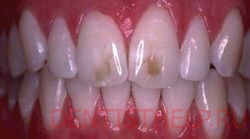 гипоплазия - показание для лечения зубной эмали