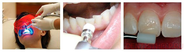 лечение гипоплазии зубной эмали