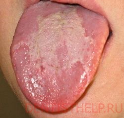 поверхностный глоссит - болезни языка