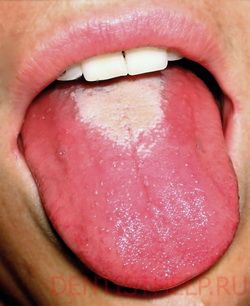 симптомы глоссита - изменение цвета языка
