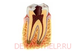глубокий кариес - одно из показаний для лечения зубов под микроскопом