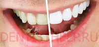 химическое отбеливание зубов