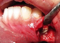 хирургический метод лечения кисты зуба или гранулемы