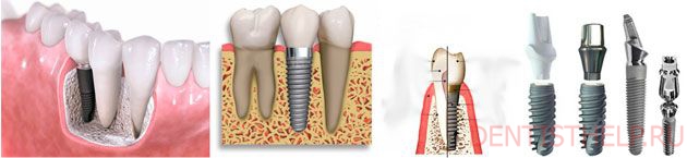 виды имплантации зубов