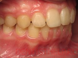 желтая эмаль зубов - одно из показаний для отбеливания зубов лазером