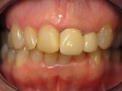 желтые зубы симптомы
