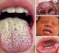 Молочница полости рта: симптомы