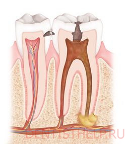 Кариес - причина возникновения кисты зуба
