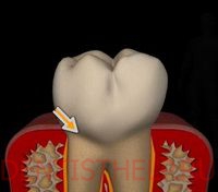 клиновидный дефект зубов