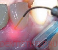 лазерная стоматология