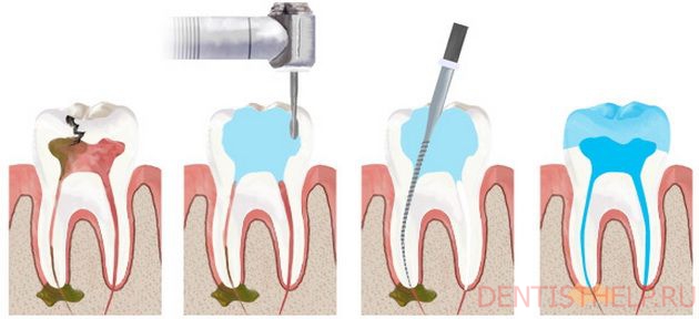 как проводится лечение зубных каналов