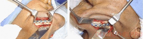 лечение перелома челюсти путем шинирования