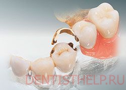 мостовидные зубные протезы на замках