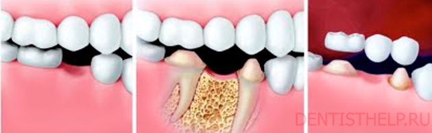 этапы установки мостовидных протезов