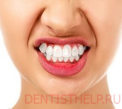 бруксизм - одно из противопоказаний при наращивании зубов