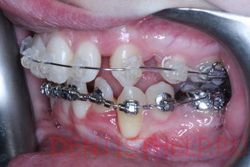 ортодонтическое лечение щелей между зубами