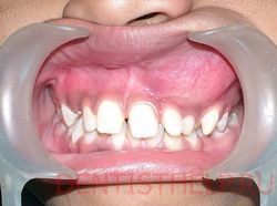 отек десны - симптомы кисты и гранулемы зуба