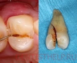 отколотый зуб - причины повреждения