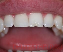 среднее повреждение отколотого зуба