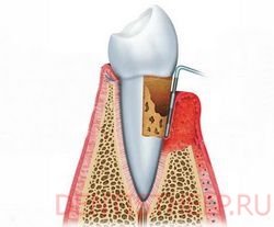 острый пародонтит
