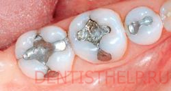 металлические зубные пломбы