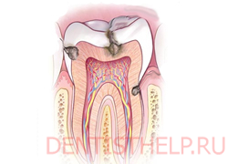 кариозные образования - одно из показаний к применению зубных пломб