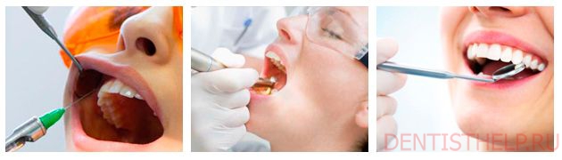 зубные пломбы: этапы установки