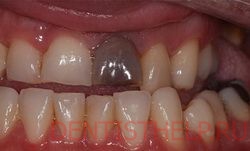 потемневшая пломба - одно из противопоказаний к фотоотбеливанию зубов