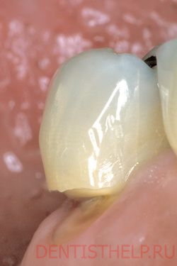 причины клиновидного дефекта зубов