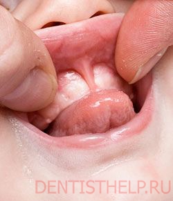 проблема уздечки губы