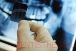 рентген-диагностика зубов