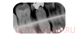 аналоговый рентген зуба
