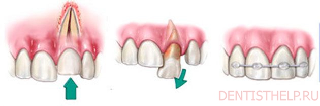реплантация зубов после травмы