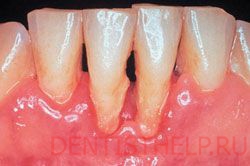пародонтоз и пародонтит - противопоказания для реплантации зубов