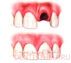 виды реплантации зубов