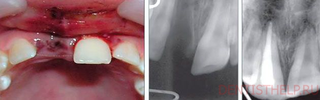 технология реплантации зубов