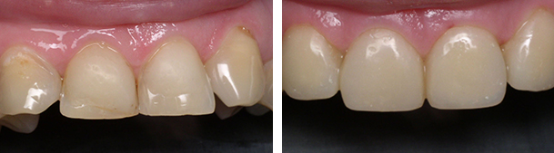 реставрация зуба до и после 