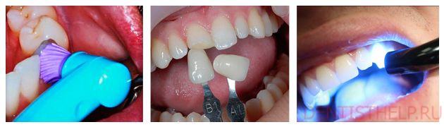 реставрация зубов композитами - технология