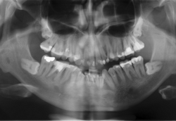 рентген снимок ретенции зуба